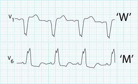 lv block pattern|left bundle branch block lv.